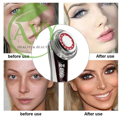 Mesotherapy Electroporation Facelifting Device